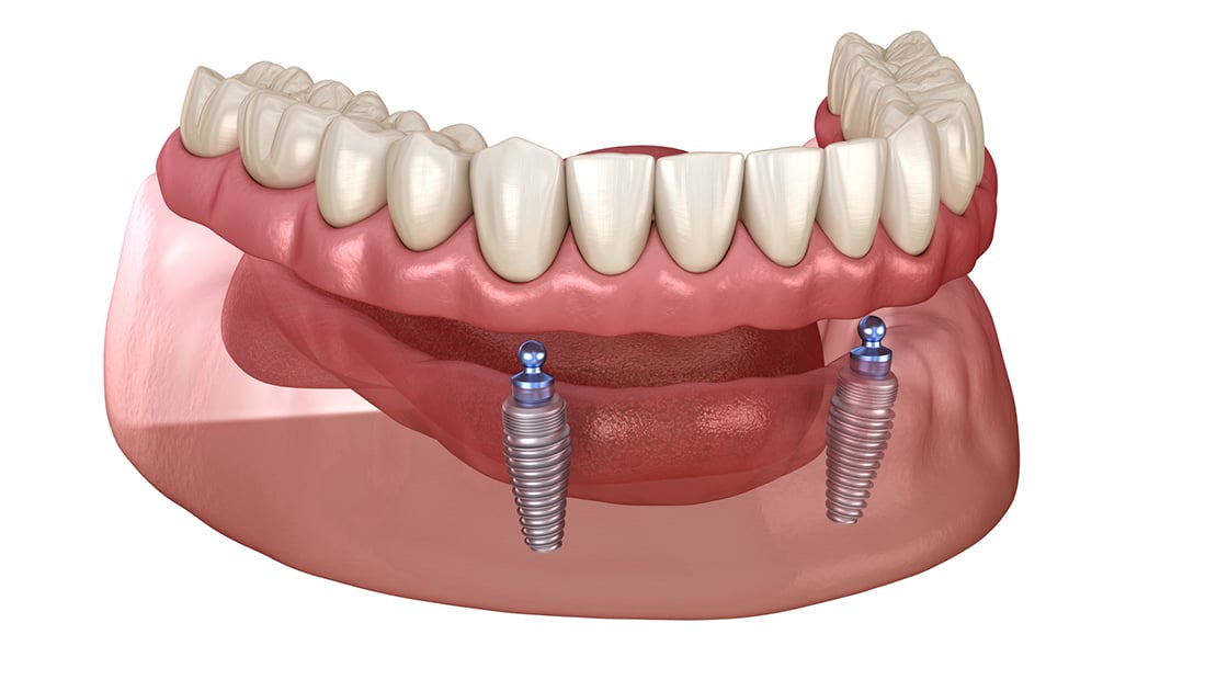 Dental Implants Graphic